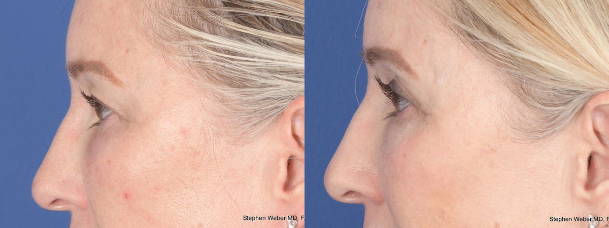 Blepharoplasty Before & After Gallery - Patient 227859 - Image 2