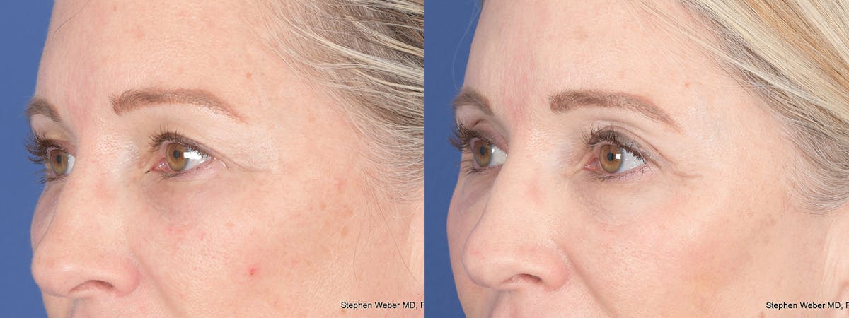 Blepharoplasty Before & After Gallery - Patient 227859 - Image 3