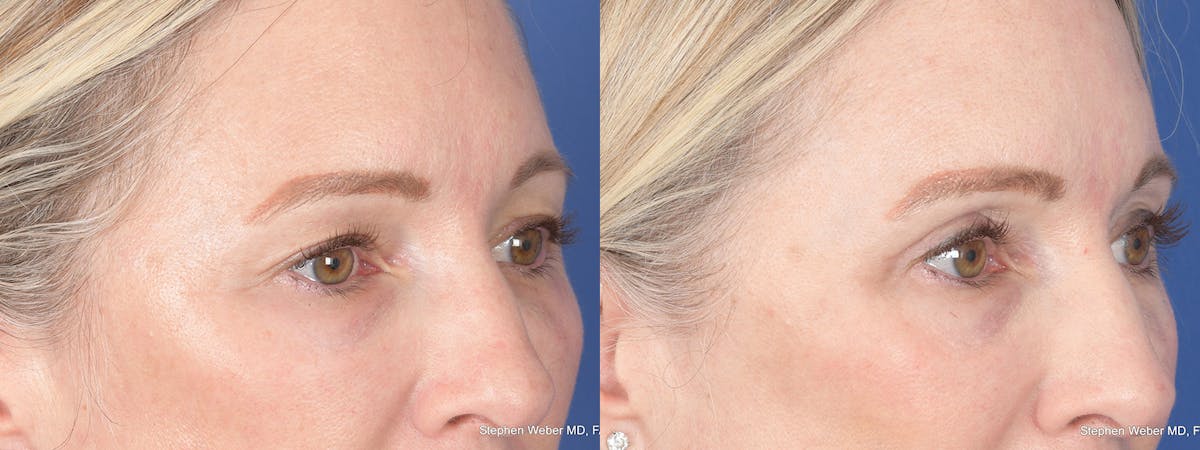 Blepharoplasty Before & After Gallery - Patient 227859 - Image 4