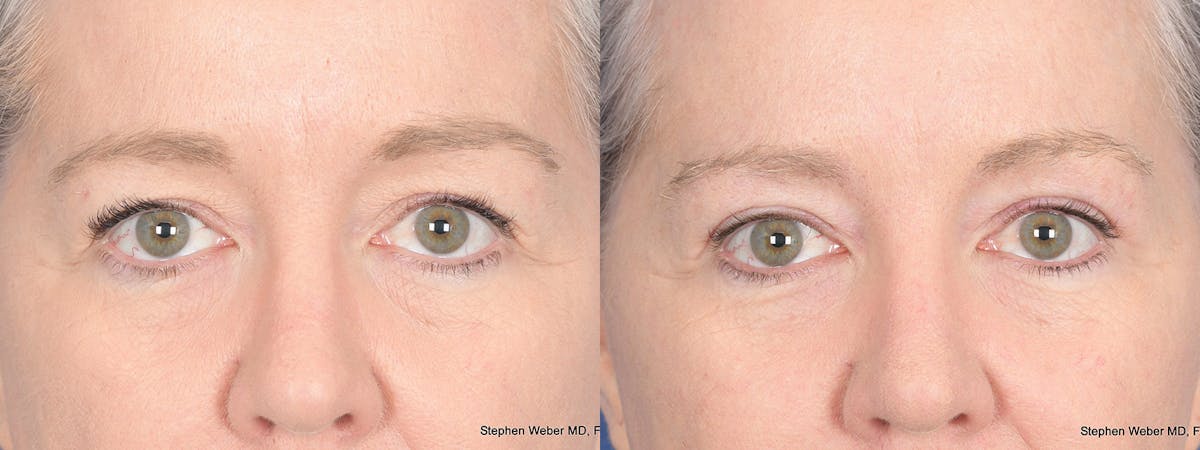 Blepharoplasty Before & After Gallery - Patient 393334 - Image 1
