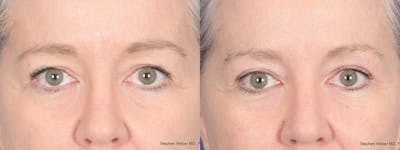 Blepharoplasty Before & After Gallery - Patient 393334 - Image 1