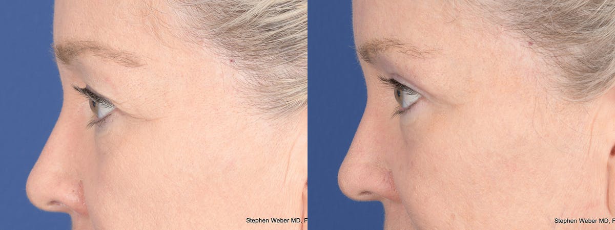 Blepharoplasty Before & After Gallery - Patient 393334 - Image 2