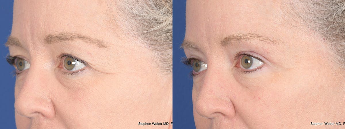 Blepharoplasty Before & After Gallery - Patient 393334 - Image 3