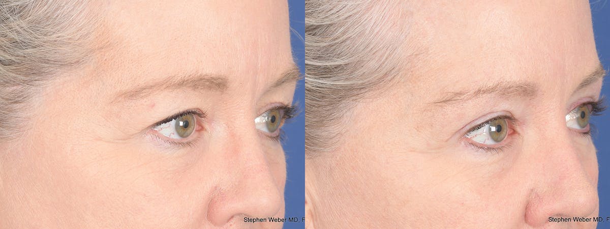 Blepharoplasty Before & After Gallery - Patient 393334 - Image 4