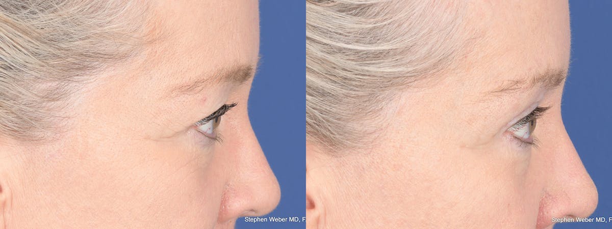 Blepharoplasty Before & After Gallery - Patient 393334 - Image 5
