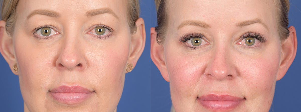 Blepharoplasty Before & After Gallery - Patient 290900 - Image 1