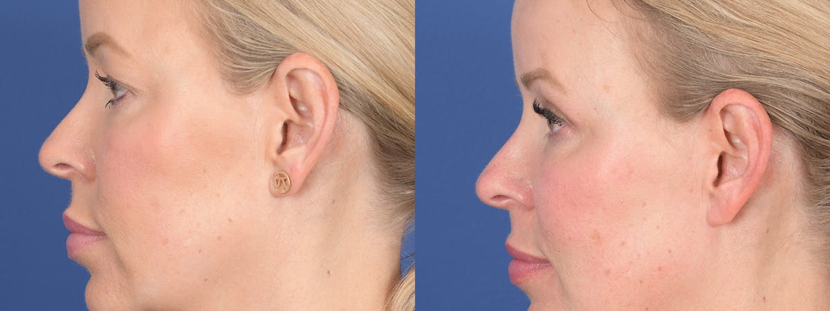 Blepharoplasty Before & After Gallery - Patient 290900 - Image 2