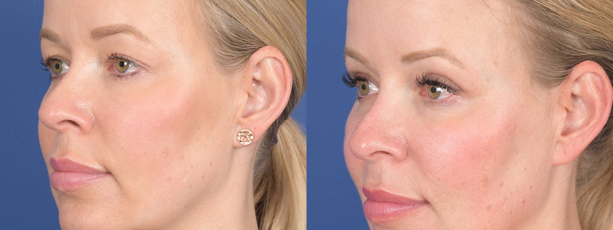 Blepharoplasty Before & After Gallery - Patient 290900 - Image 3