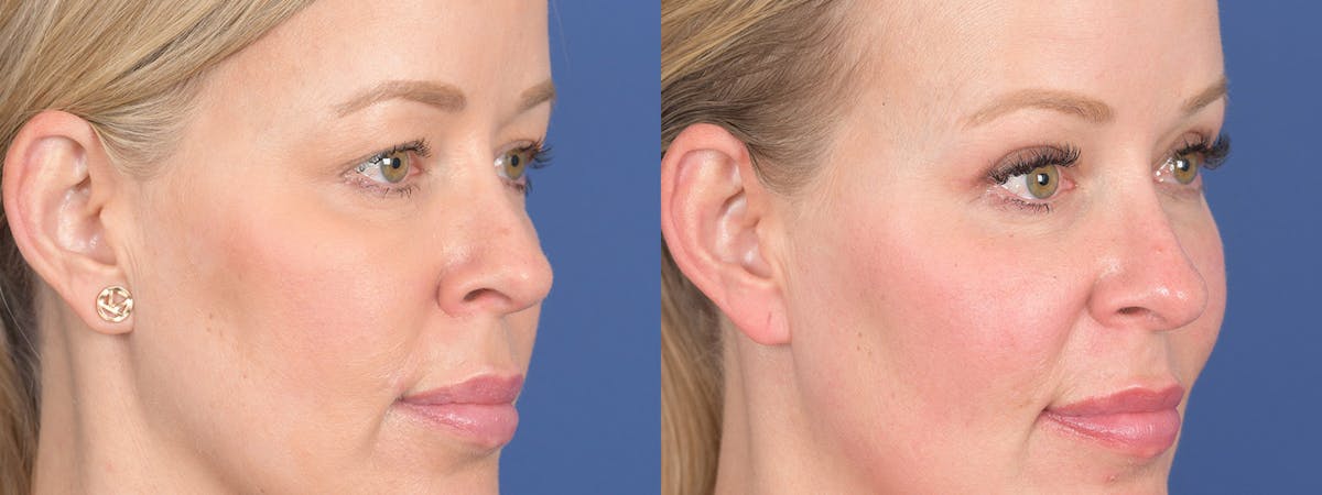 Blepharoplasty Before & After Gallery - Patient 290900 - Image 4