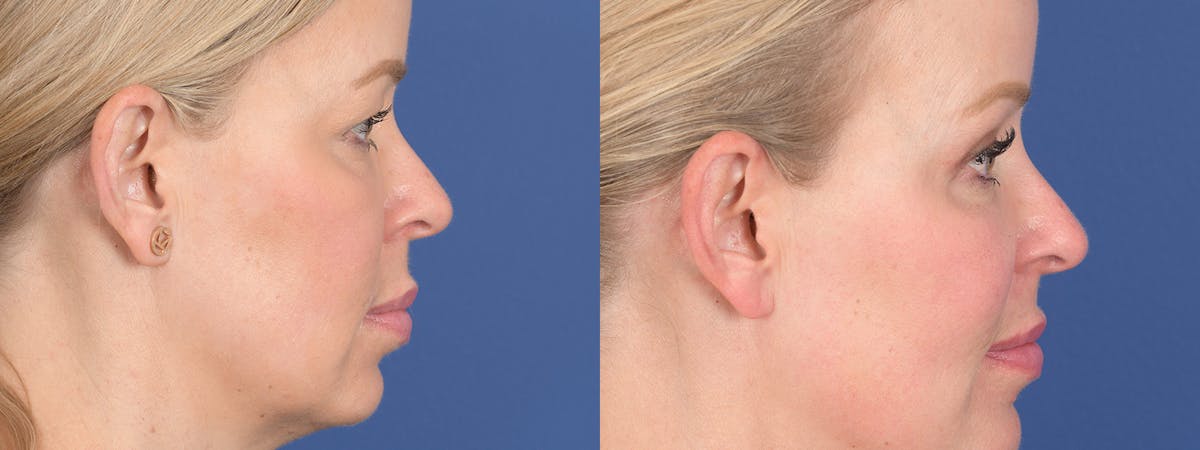 Blepharoplasty Before & After Gallery - Patient 290900 - Image 5