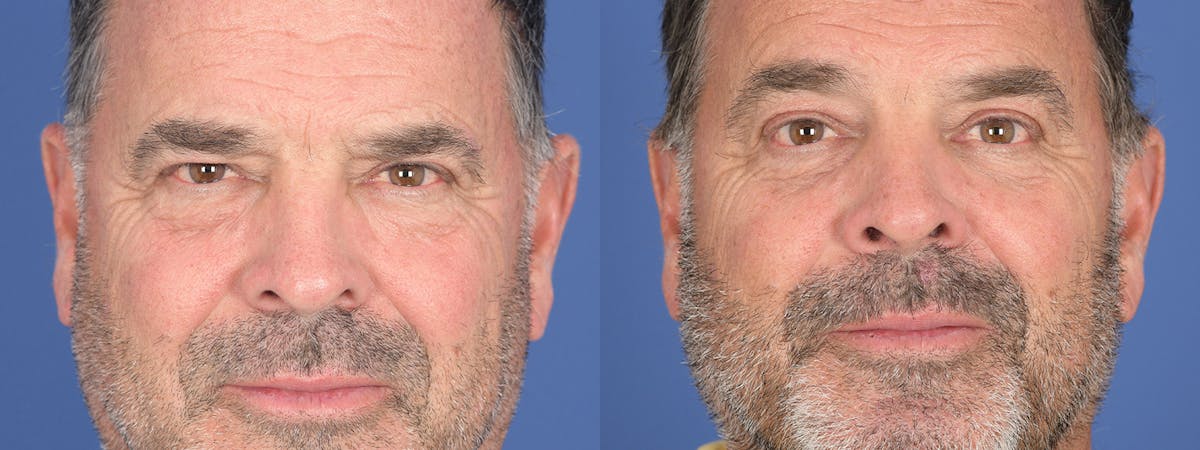Blepharoplasty Before & After Gallery - Patient 402183 - Image 1