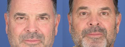 Blepharoplasty Before & After Gallery - Patient 402183 - Image 1