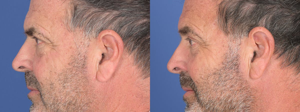 Blepharoplasty Before & After Gallery - Patient 402183 - Image 2