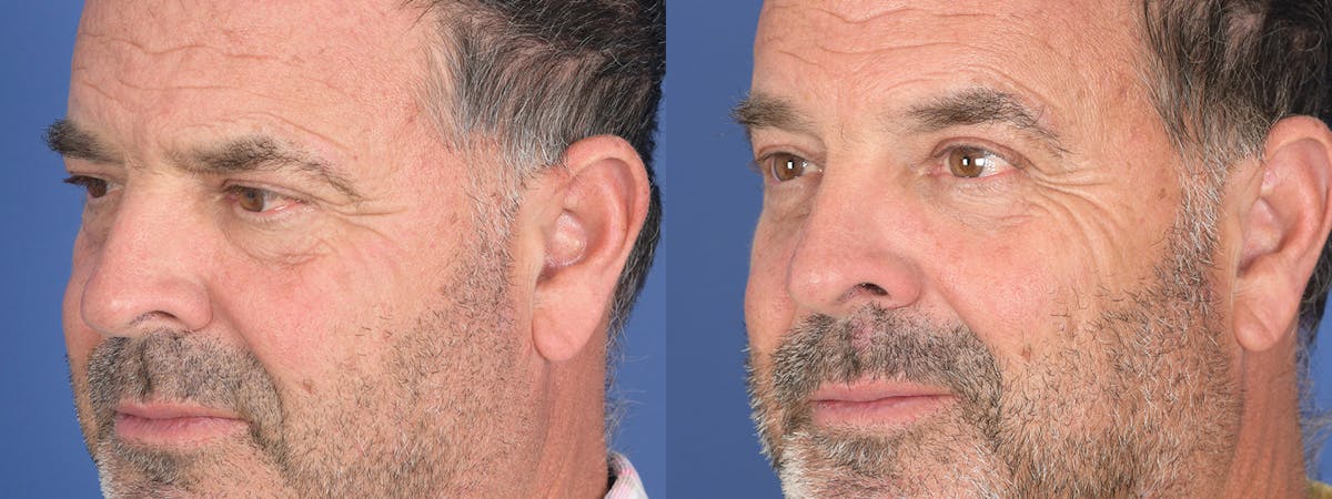 Blepharoplasty Before & After Gallery - Patient 402183 - Image 3