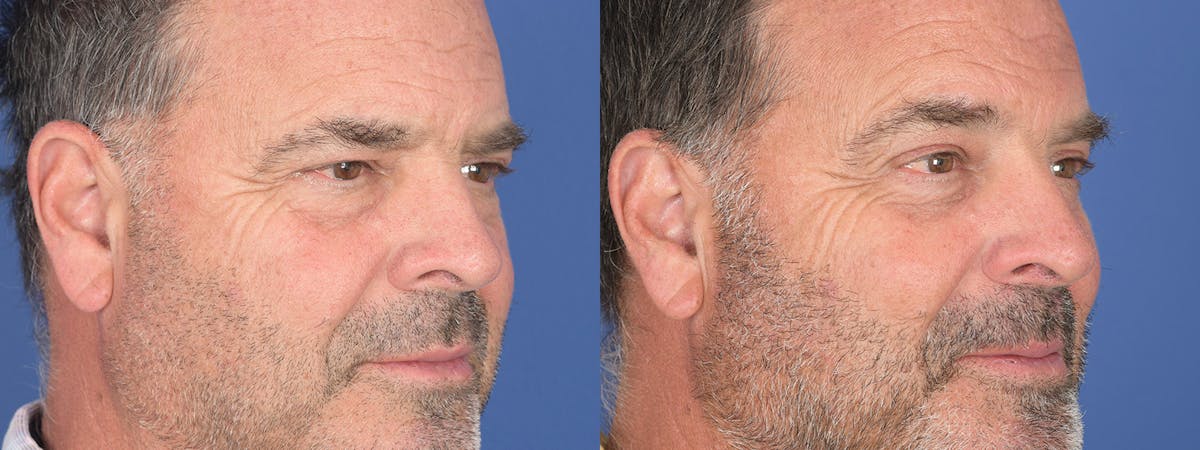 Blepharoplasty Before & After Gallery - Patient 402183 - Image 4