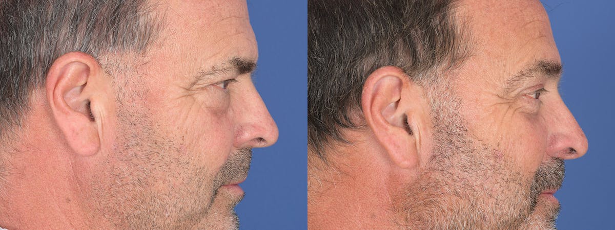 Blepharoplasty Before & After Gallery - Patient 402183 - Image 5