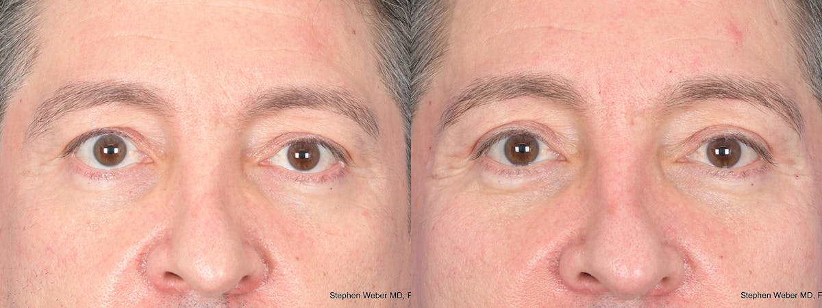 Blepharoplasty Before & After Gallery - Patient 127007 - Image 1
