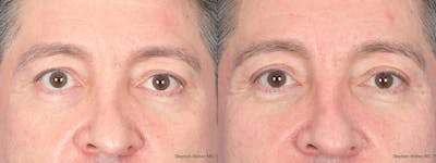 Blepharoplasty Before & After Gallery - Patient 127007 - Image 1