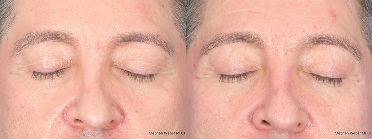 Blepharoplasty Before & After Gallery - Patient 127007 - Image 2