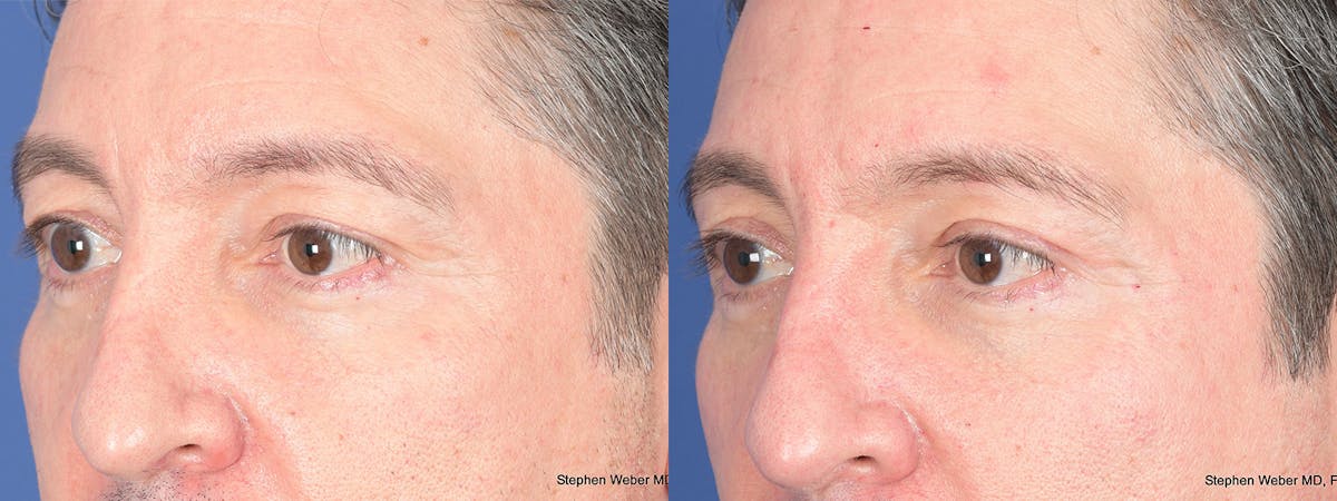 Blepharoplasty Before & After Gallery - Patient 127007 - Image 3