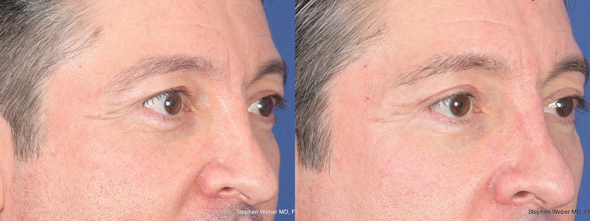 Blepharoplasty Before & After Gallery - Patient 127007 - Image 4