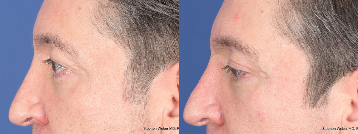 Blepharoplasty Before & After Gallery - Patient 127007 - Image 5
