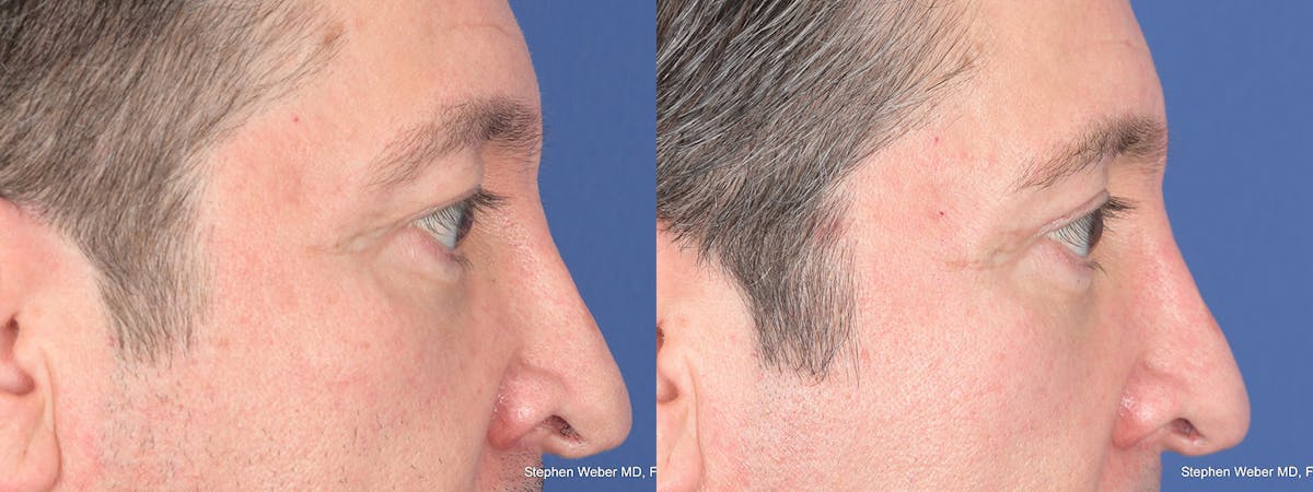 Blepharoplasty Before & After Gallery - Patient 127007 - Image 6