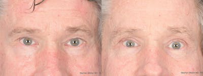 Blepharoplasty Before & After Gallery - Patient 284424 - Image 1
