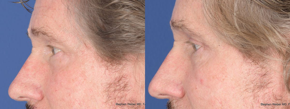 Blepharoplasty Before & After Gallery - Patient 284424 - Image 2