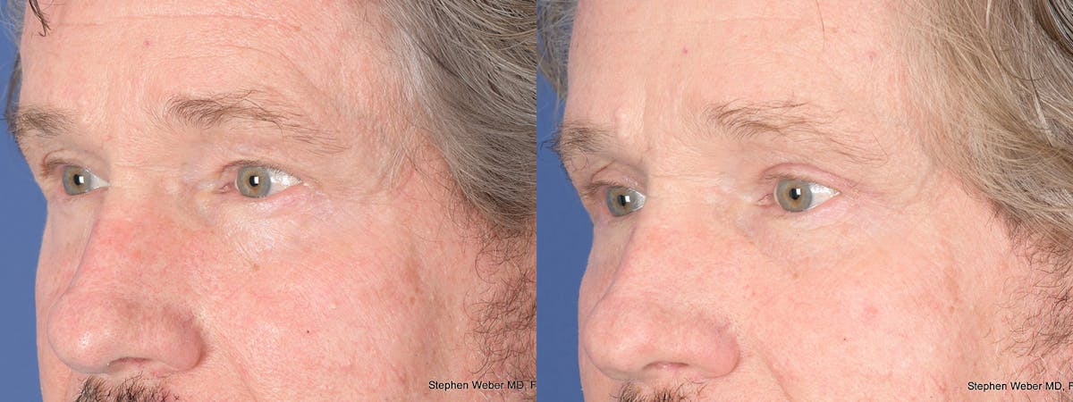 Blepharoplasty Before & After Gallery - Patient 284424 - Image 3