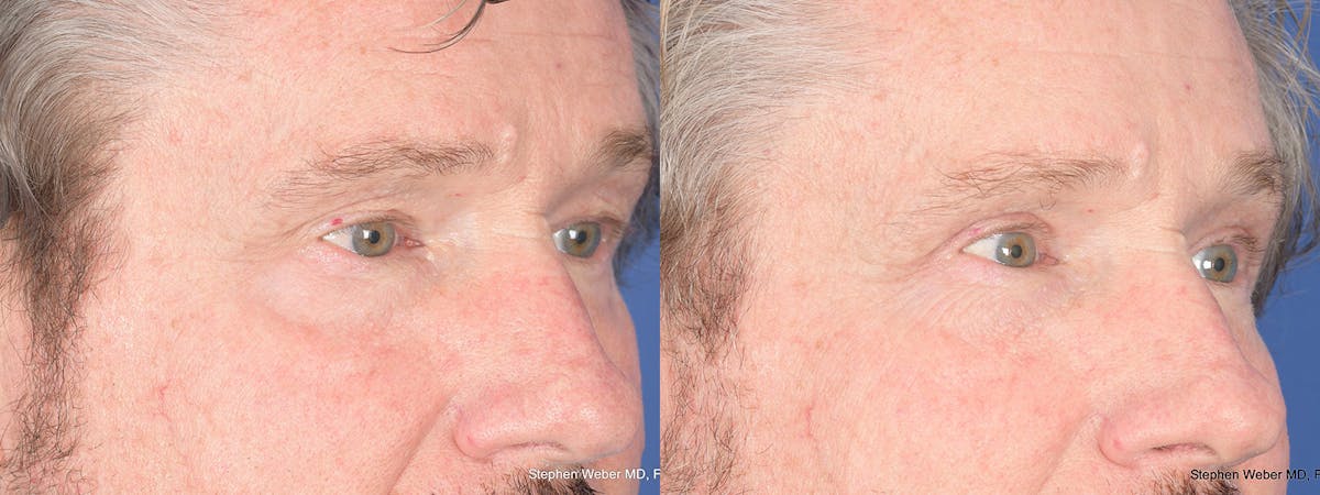 Blepharoplasty Before & After Gallery - Patient 284424 - Image 4