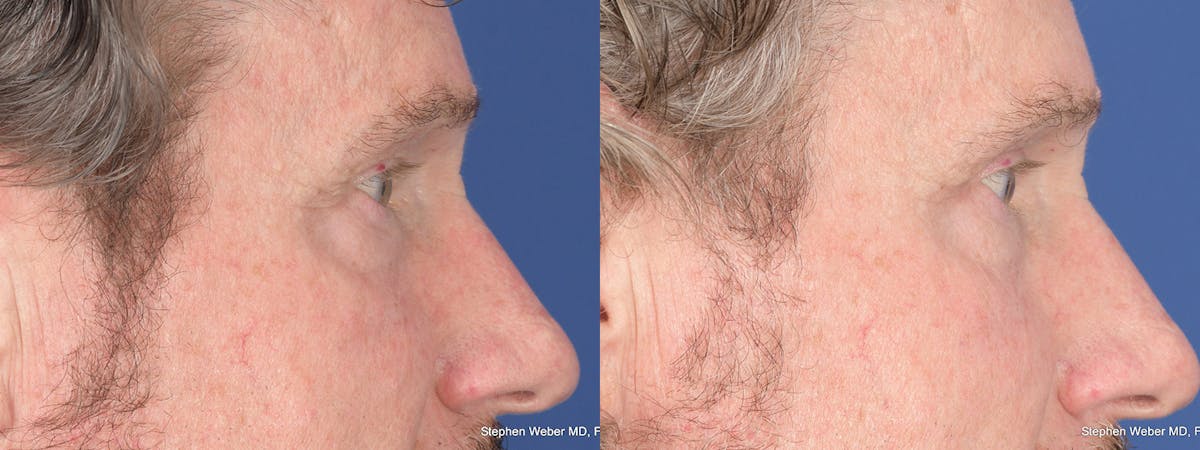 Blepharoplasty Before & After Gallery - Patient 284424 - Image 5