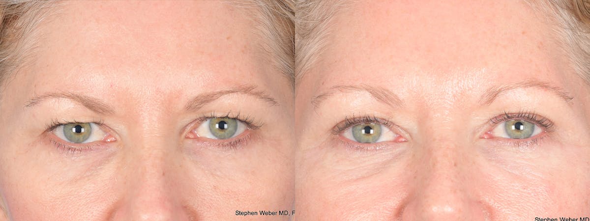 Blepharoplasty Before & After Gallery - Patient 362885 - Image 1