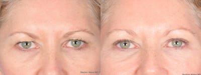 Blepharoplasty Before & After Gallery - Patient 362885 - Image 1