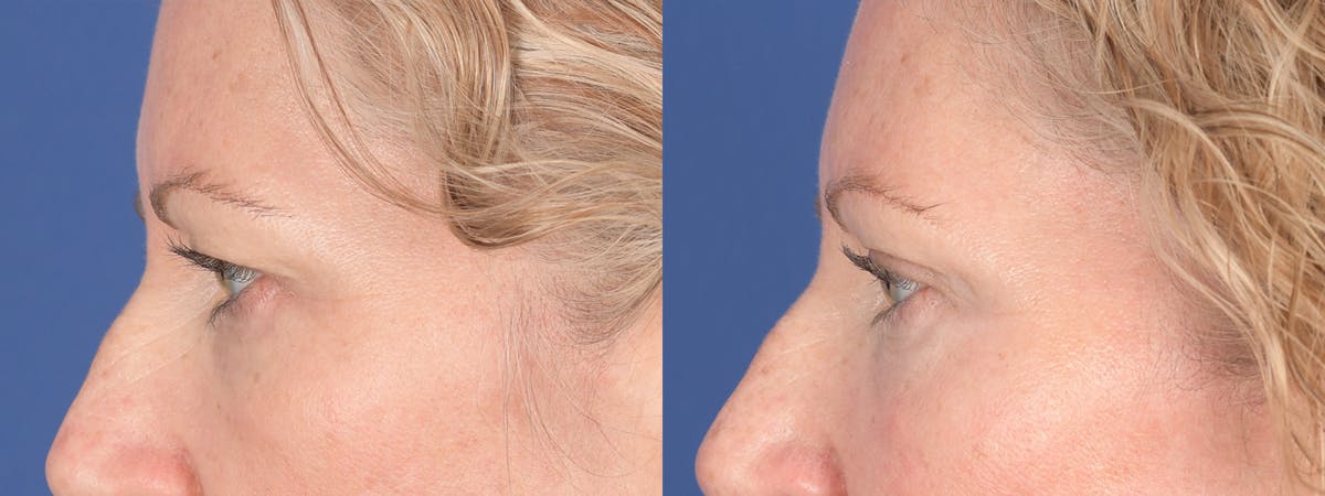 Blepharoplasty Before & After Gallery - Patient 362885 - Image 2