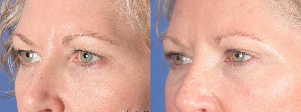 Blepharoplasty Before & After Gallery - Patient 362885 - Image 3