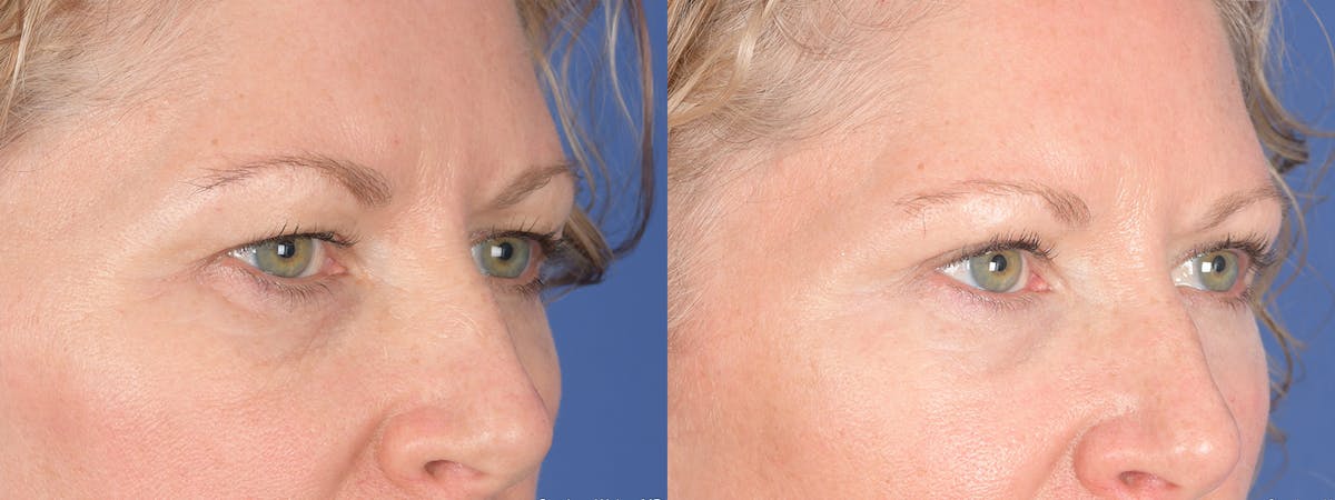 Blepharoplasty Before & After Gallery - Patient 362885 - Image 4