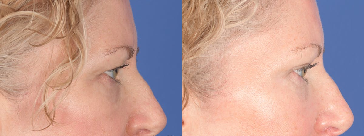 Blepharoplasty Before & After Gallery - Patient 362885 - Image 5