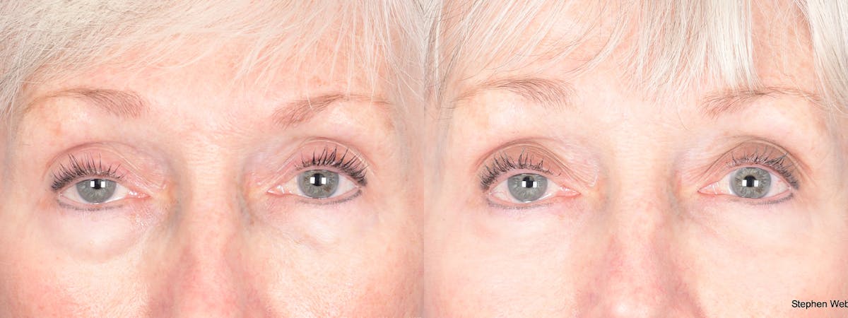 Blepharoplasty Before & After Gallery - Patient 288600 - Image 1