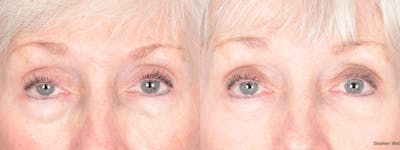 Blepharoplasty Before & After Gallery - Patient 288600 - Image 1