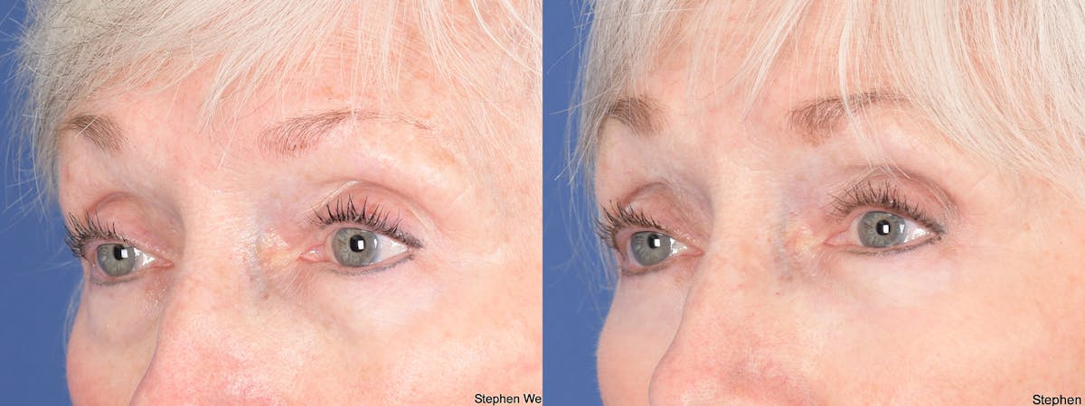 Blepharoplasty Before & After Gallery - Patient 288600 - Image 2