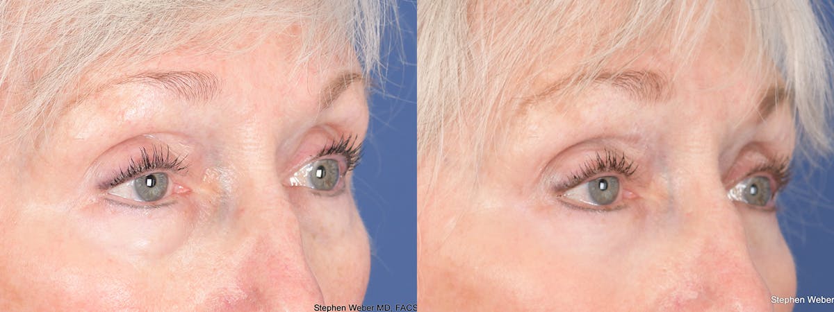 Blepharoplasty Before & After Gallery - Patient 288600 - Image 3