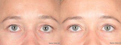 Blepharoplasty Before & After Gallery - Patient 124223 - Image 1
