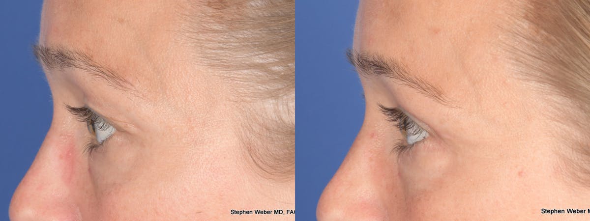 Blepharoplasty Before & After Gallery - Patient 124223 - Image 2
