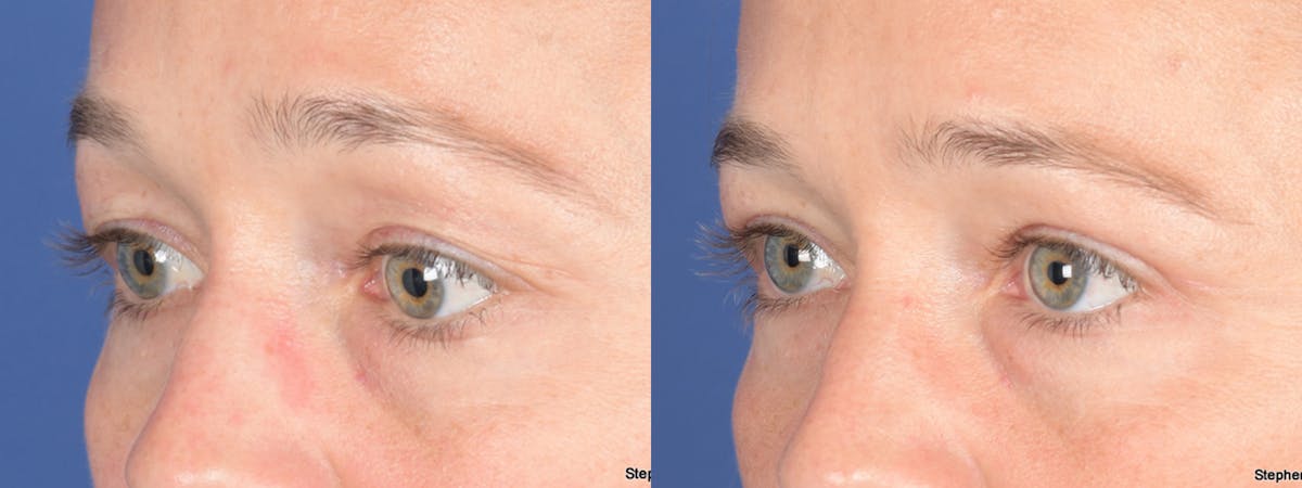 Blepharoplasty Before & After Gallery - Patient 124223 - Image 3