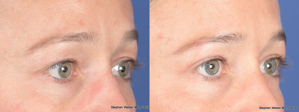 Blepharoplasty Before & After Gallery - Patient 124223 - Image 4