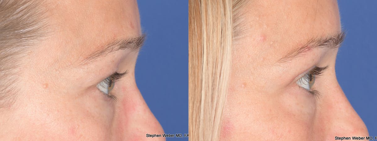 Blepharoplasty Before & After Gallery - Patient 124223 - Image 5