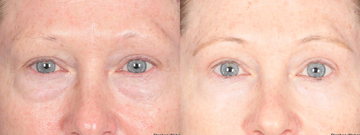 Blepharoplasty Before & After Gallery - Patient 193488 - Image 1