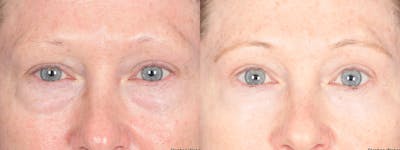 Blepharoplasty Before & After Gallery - Patient 193488 - Image 1