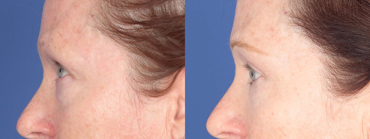 Blepharoplasty Before & After Gallery - Patient 193488 - Image 2